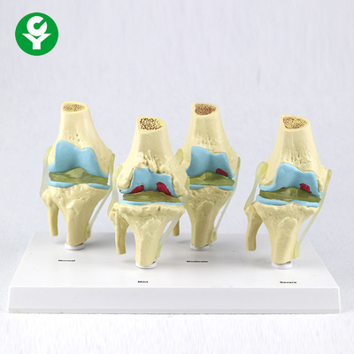 Four Stage Pathological Human Joints Model / Learning Knee Model Anatomy
