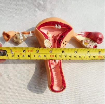 Female Anatomical Model Pathological Uterine Vagina Genitourinary